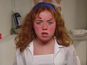 Sunburn